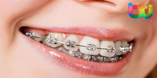 Beberapa Ramuan Untuk Memutihkan Gigi Alami Terhadap Pengguna Kawat Gigi