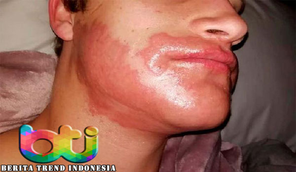 Iseng Warnai Janggut, Laki-laki Ini Malah Alami Luka Bakar